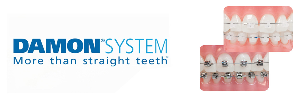 damon sistem ispravljanje zuba